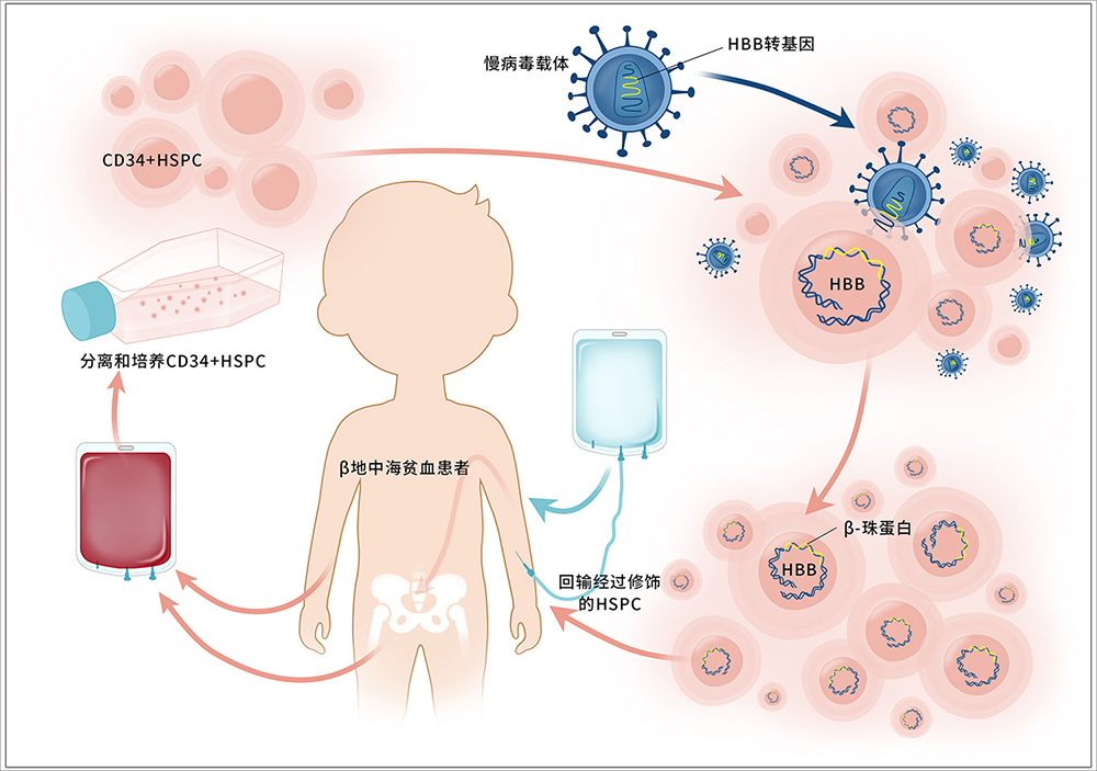 The first domestic case of Treatment of Double β0 Severe Thalassemia with Lentiviral Gene Modification Technology achieved a major breakthrough(图3)